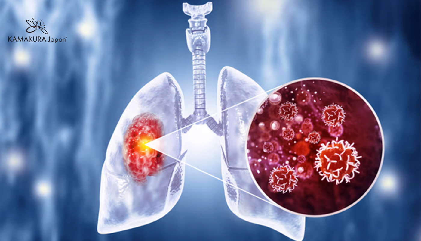 Phương pháp chữa ung thư phổi mới hiện nay – Cơ hội điều trị hiệu quả tại nước ngoài cùng Kamakura